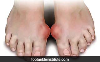 Study Uncovers Major Causes of Gout, Dispelling Common Myths